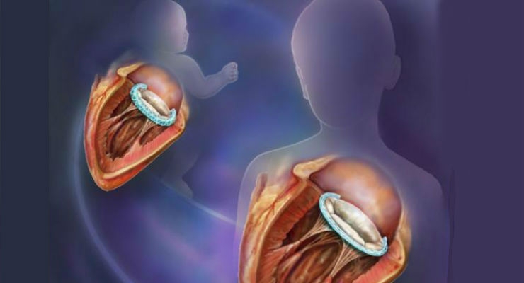 cardiac implant devices